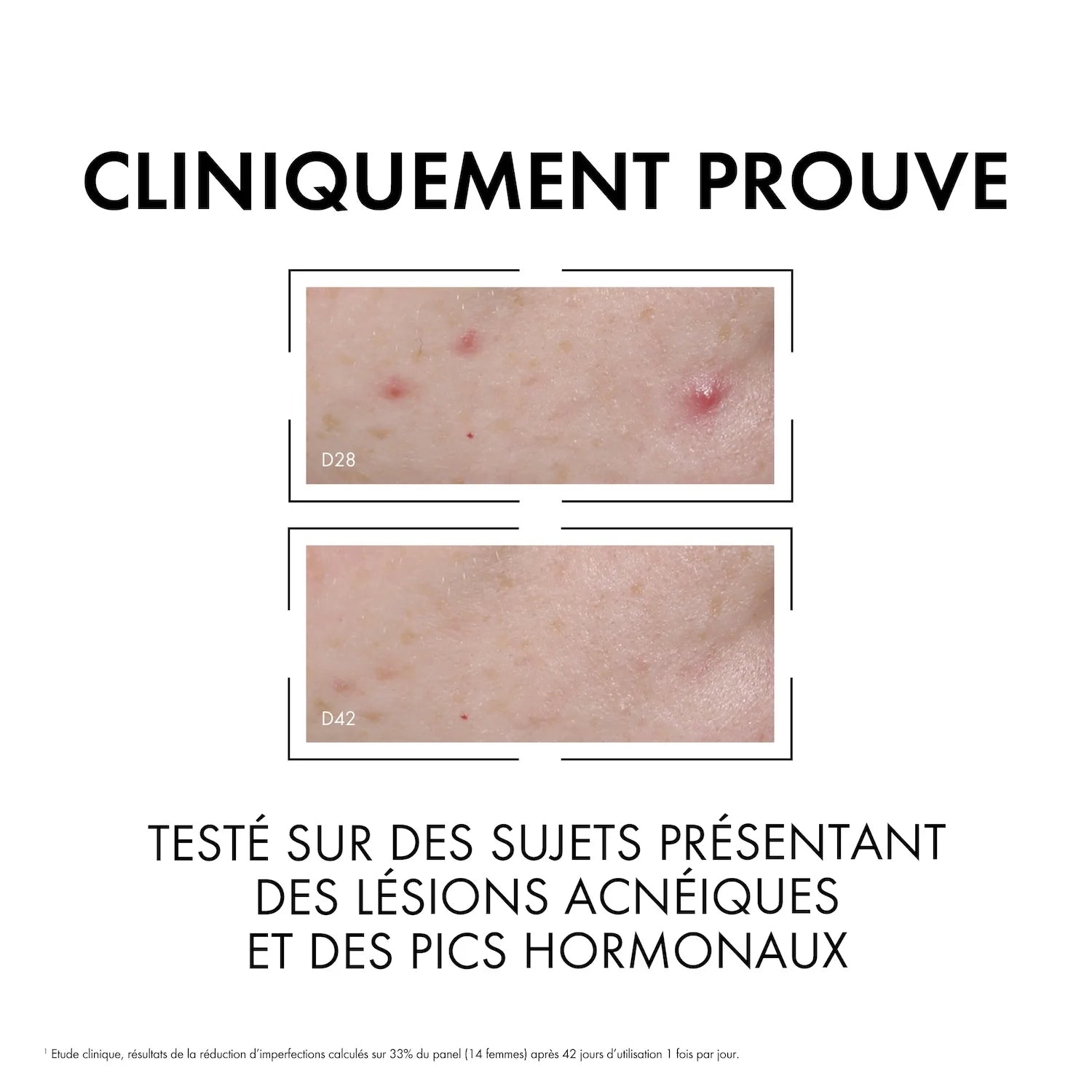 Résultats Avant Après Normaderm Sérum Réduction Imperfections Pores Affinés Teint Unifié - novaparapharmacie