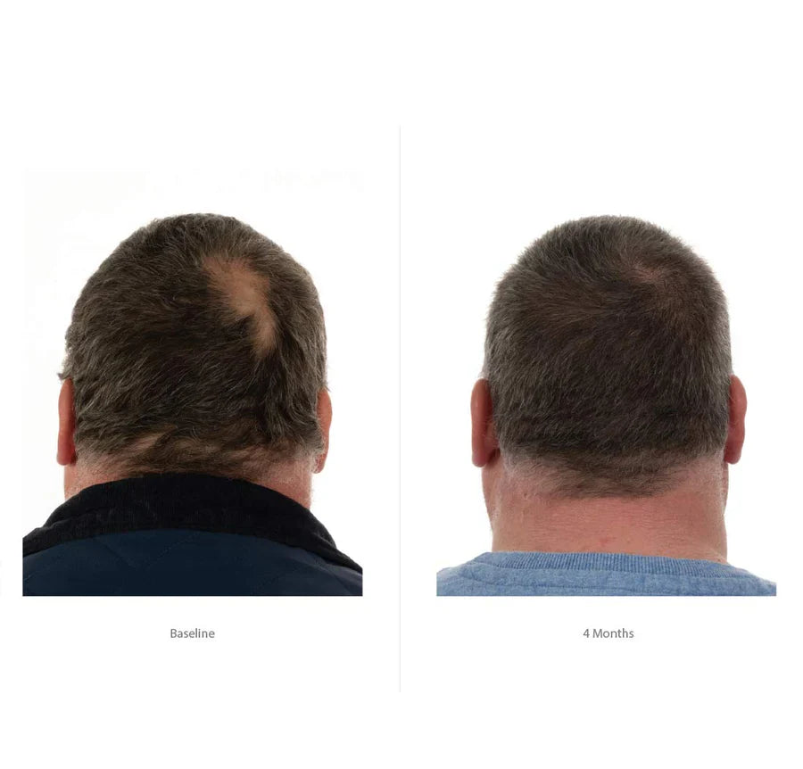 Foligain bénéfices triple action anti-chute trioxidil 10% ultra-concentré densité volume traitement intensif homme - novaparapharmacie