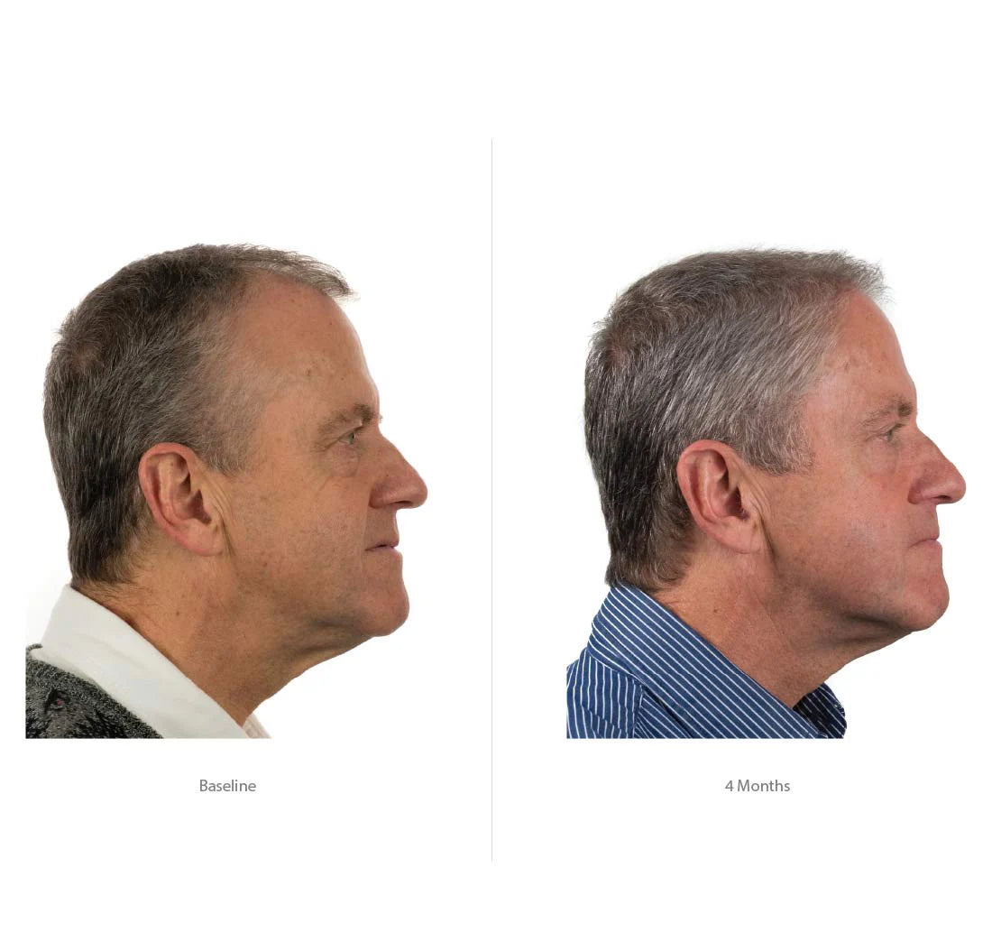 Foligain application mode emploi traitement anti-chute conditioner trioxidil 2% homme densité volume - novaparapharmacie