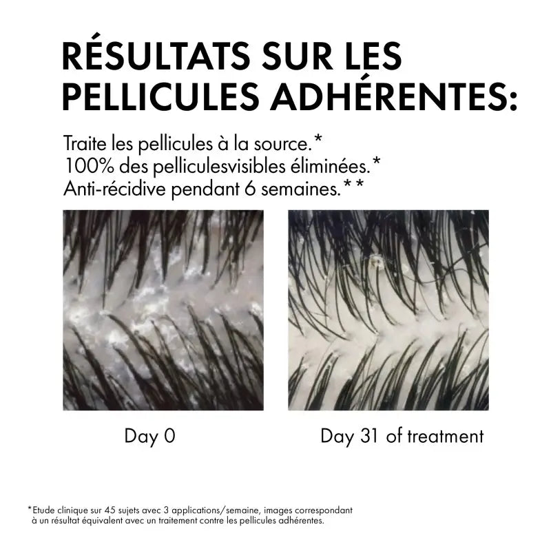 VICHY Dercos Shampooing résultats traitant antipelliculaire cheveux normaux gras pellicules élimination cuir chevelu sain - novaparapharmacie