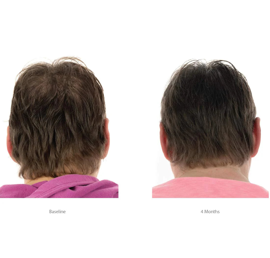 Foligain bénéfices triple action anti-chute trioxidil 2% concentré densité volume douceur brillance femme - novaparapharmacie