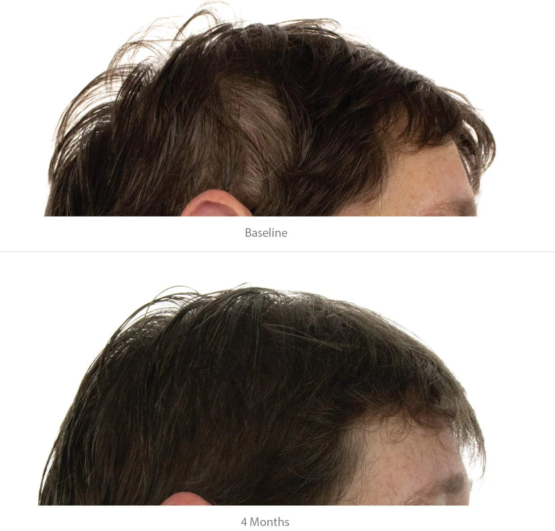 Foligain bénéfices triple action anti-chute trioxidil 2% concentré densité volume douceur préservée femme - novaparapharmacie